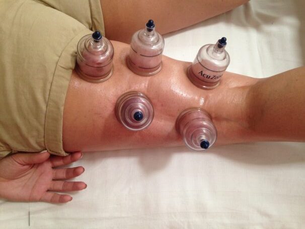 Cupping og Bindevævsmassage